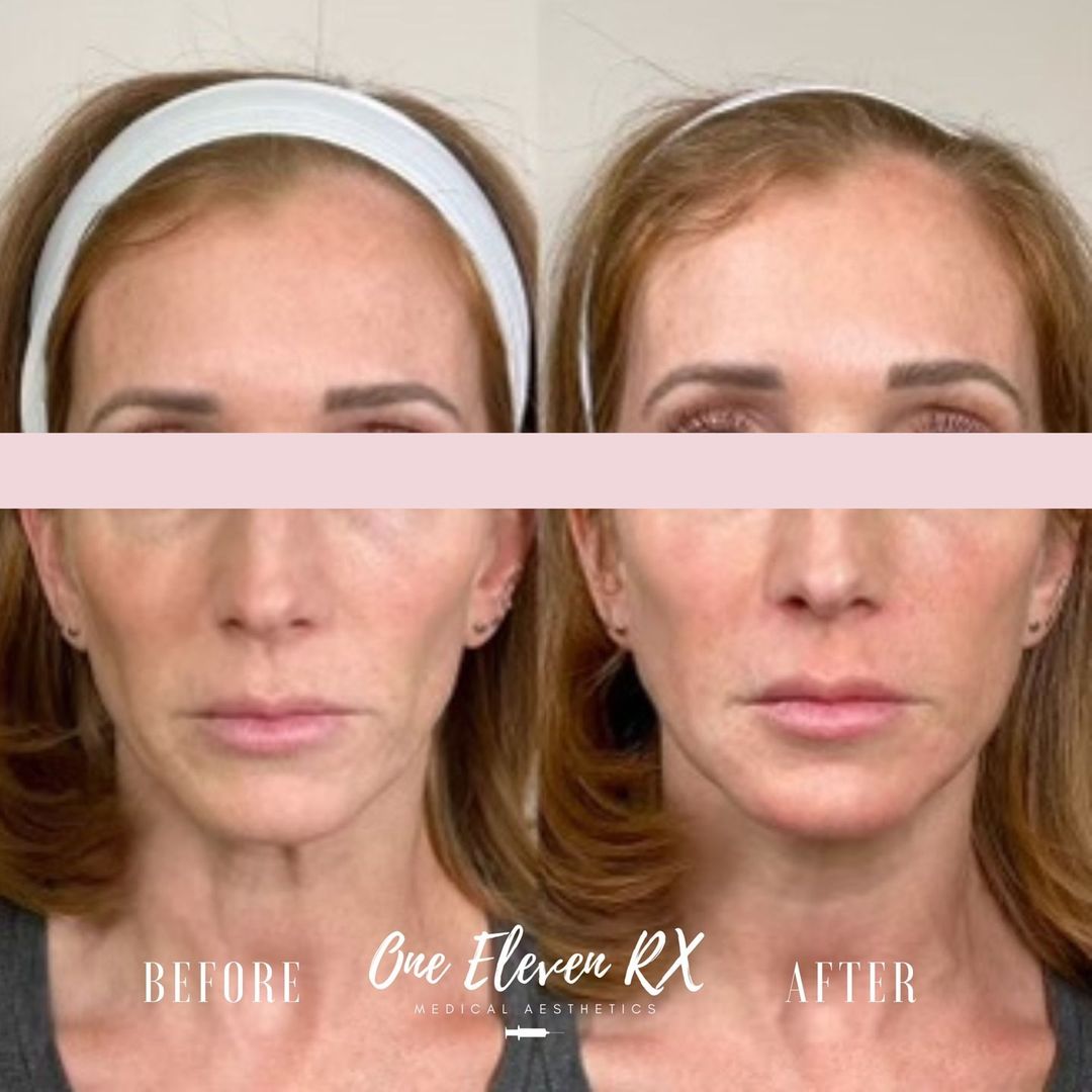 Before and After Treatment Image | One Eleven RX in Auburn, MA