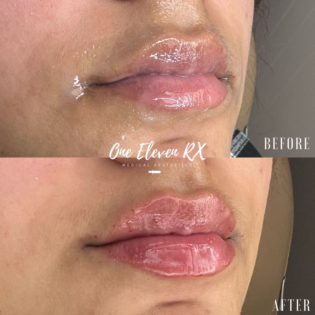 Before and After Lip Treatment Image | One Eleven RX in Auburn, MA